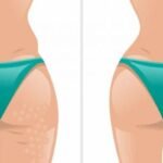 how to get rid of butt acne