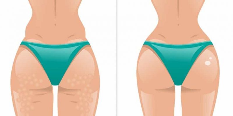 how to get rid of butt acne