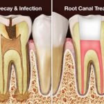 Root Canal Treatment