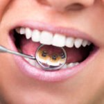 Invisible Braces