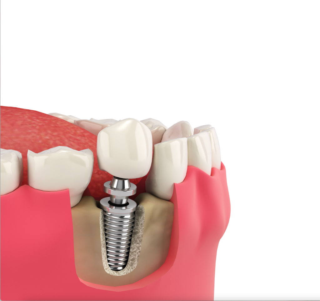 A single tooth implant