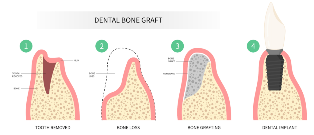 A dental implant is supported with bone grafting