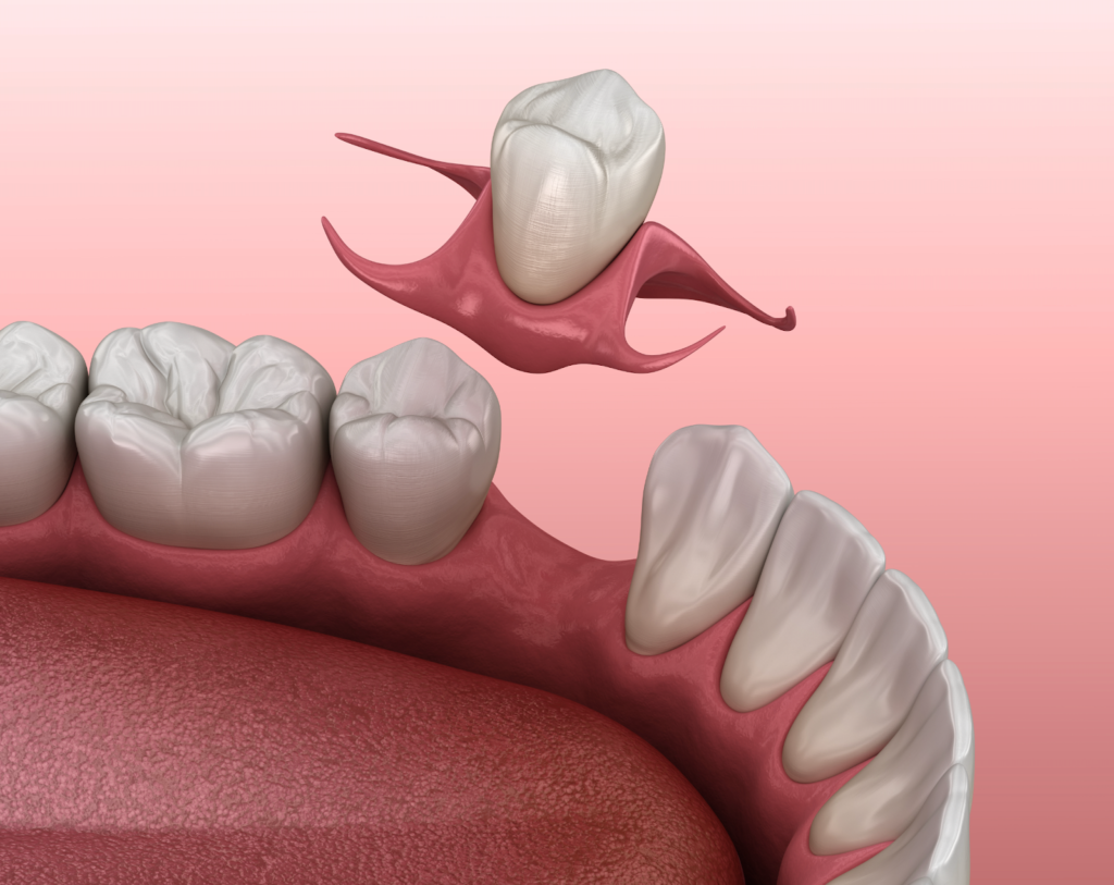 A partial denture replaces a single missing tooth