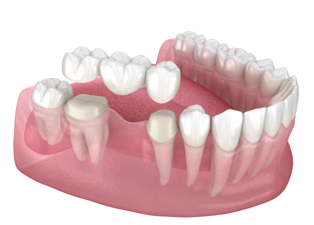 A tooth-supported bridge sits over the top of the existing teeth to secure the tooth bridge.