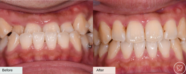 Invisalign Before and After Underbite