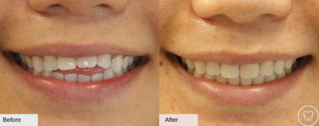 Invisalign Before and After Open Bite
