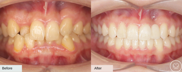 Invisalign Before and After Crossbite
﻿