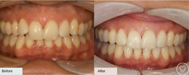 Invisalign Before and After Overbite
