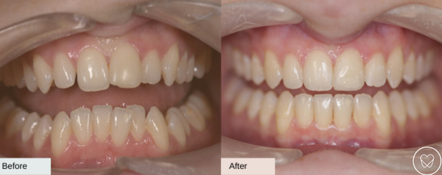 Invisalign Before and After Teeth Straightening