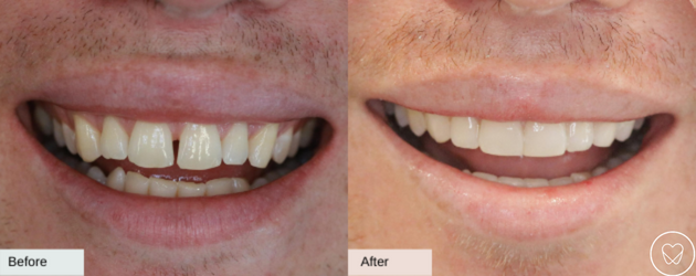 Invisalign Before and After Gapped Teeth