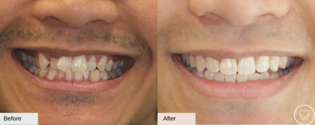 Invisalign Before and After Overcrowding