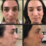 Microneedling